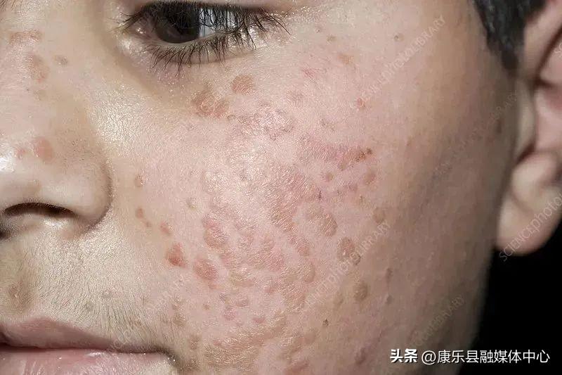 身上長了HPV，我們該如何面對與處理